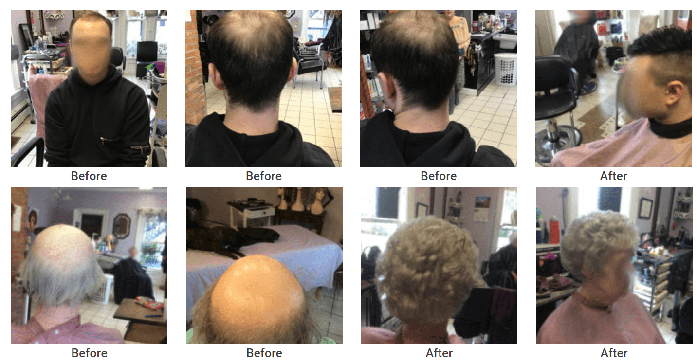 Hair Restoration Hair Replacement Bald Hair Treatment